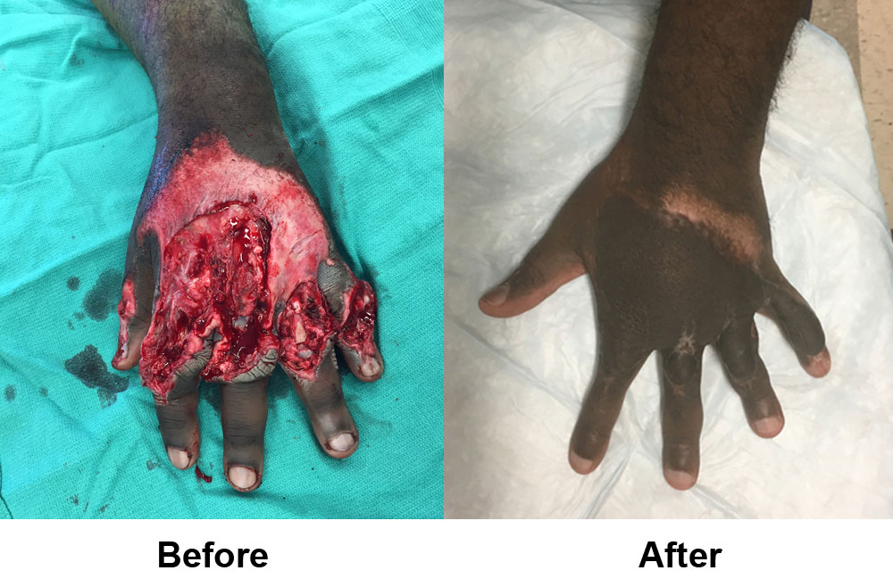 Before and after patient with hand injury